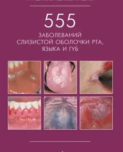 555 diseases of the mucous membrane of the mouth